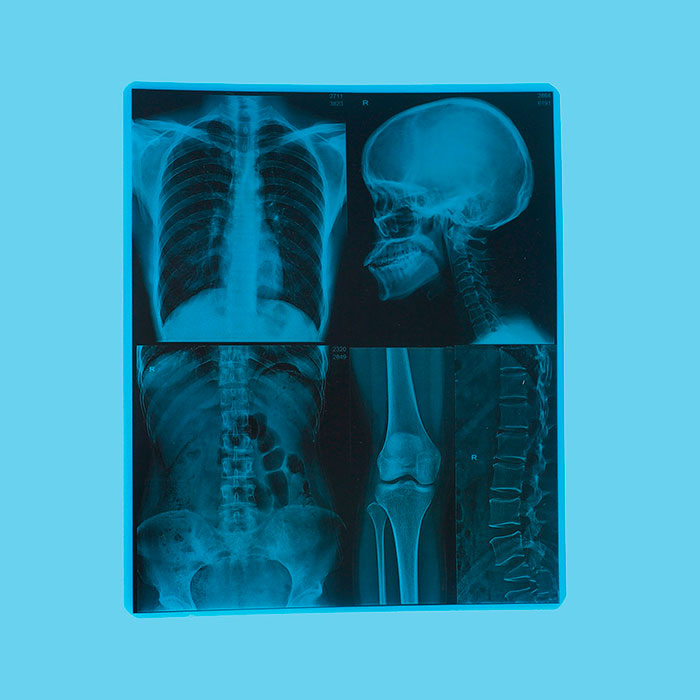 医用干式激光胶片